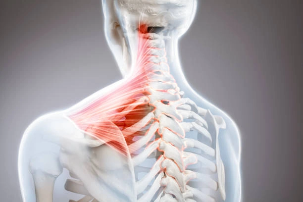The Sedentary Desk Worker’s Survival Guide: 9 Home Rehab Exercises to Eliminate Lower Back Pain, Anterior Pelvic Tilt, and "Tech Neck" 4 3D anatomical illustration highlighting a red inflamed trapezius muscle and upper back pain connected to chronic lower back pain from sitting